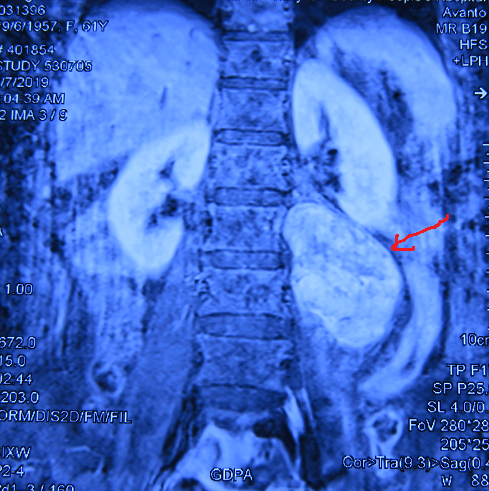术前MRI冠状位  箭头所指为肿块.png
