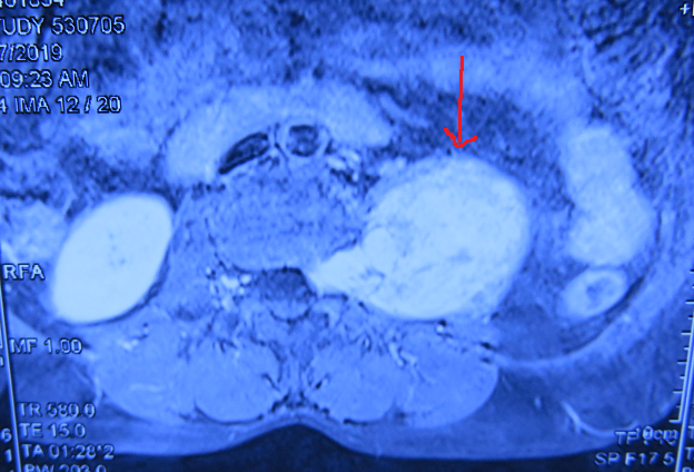 术前MRI水平位  箭头所指为肿块，肿块进入椎管.png