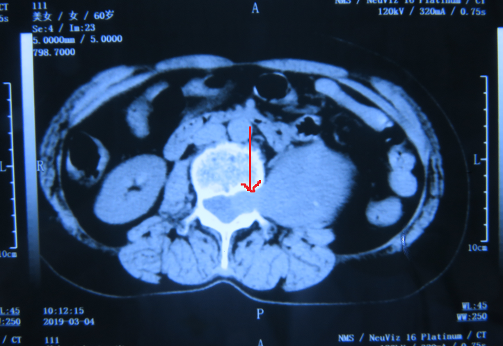 术前CT   箭头所指肿块经椎间孔进入椎管.png