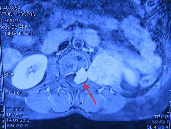 术前MRI水平位  箭头所指为肿块，肿块进入椎管2.png