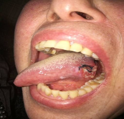 舌头上长瘤图片